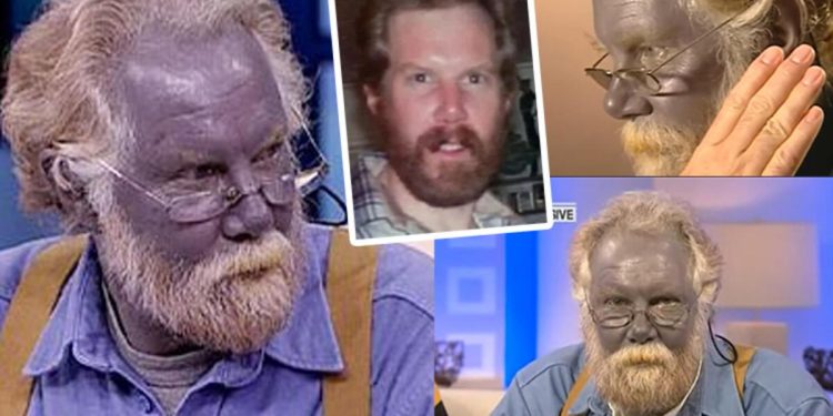 İçtiği karışım yüzünden cildi maviye dönüştü… ‘Şirin baba Paul’ yeniden dünya gündeminde…